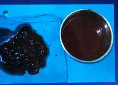 Bác sỹ lấy máu đông ra khỏi ngực nữ bệnh nhân Q. (Ảnh: PV/Vietnam+) Lấy cục máu đông 500g trong ngực một phụ nữ sau khi 'nâng' vòng một ảnh 2