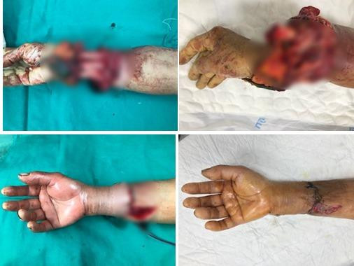 Nối thành công bàn tay một phụ nữ bị đứt rời do máy tuốt lúa ảnh 1