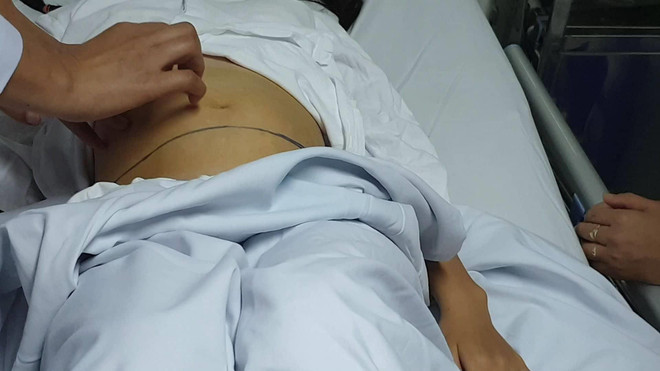 Khối u trên cơ thể của bệnh nhân. (Ảnh: PV/Vietnam+) Phẫu thuật nội soi lấy khối u quái buồng trứng cho bé gái 12 tuổi ảnh 1