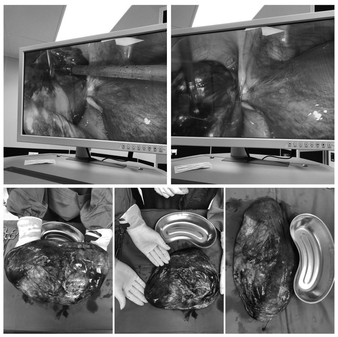 Thai phụ mang khối u buồng trứng xoắn có kích thước hơn 30cm ảnh 2