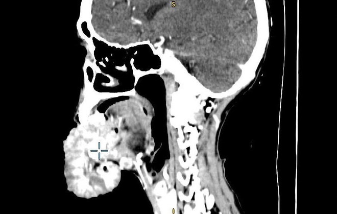 Phẫu thuật cắt bỏ khối u ung thư đường kính 20cm ở môi một phụ nữ ảnh 1