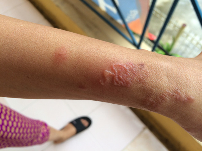 Tay của một bệnh nhân nhiễm giun đũa chó, mèo từ thú cưng trong nhà. (Ảnh: PV/Vietnam+) Cảnh báo nhiễm ký sinh trùng từ thú cưng nhưng lầm tưởng là dị ứng ảnh 1