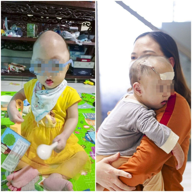 Tạo hình dạng hộp sọ cho bé gái bị dị dạng, đầu có hình tháp ảnh 2