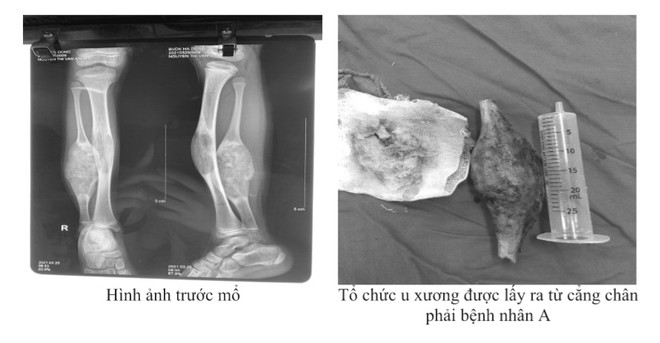 Tưởng đau chân, bé 10 tuổi phát hiện với khối u xương chày lớn ảnh 2