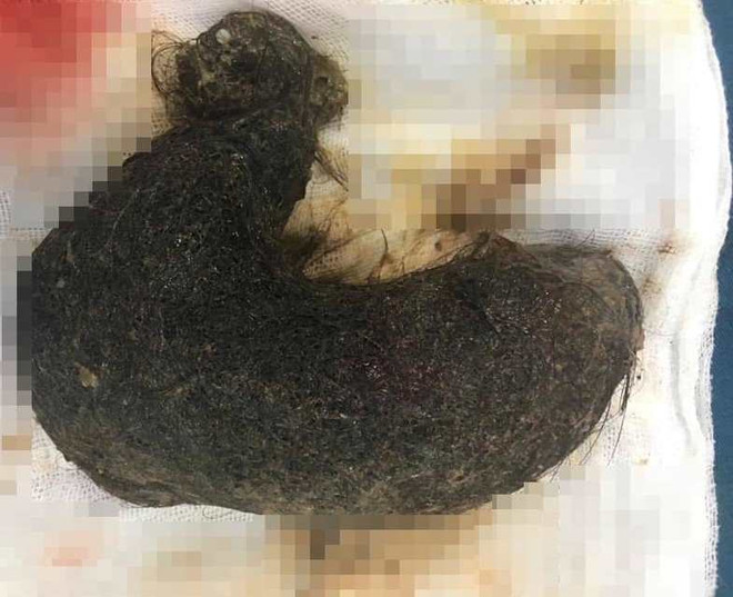 Khối u tóc khổng lồ dài 20 cm trong cơ thể bé gái 11 tuổi ảnh 1