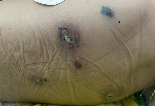 Cứu sống bệnh nhi sốc nhiễm khuẩn nguy hiểm do vi khuẩn hiếm gặp ảnh 1