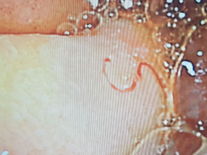 Giun mỏ lúc nhúc đâm thủng gây chảy máu ồ ạt ruột non một nam giới ảnh 2