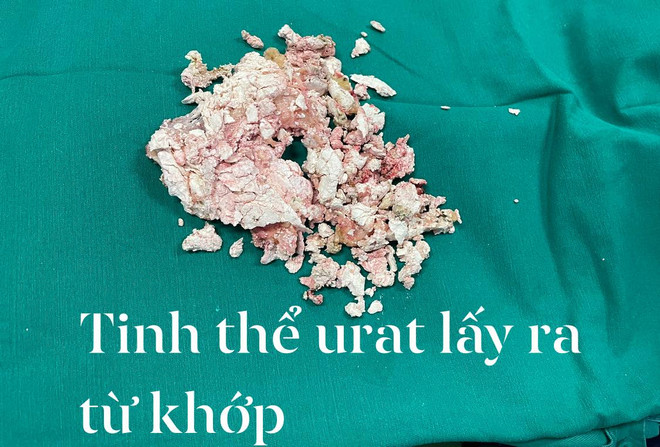 Nam bệnh nhân 38 tuổi phải thay khớp gối 2 bên do bệnh gout ảnh 2