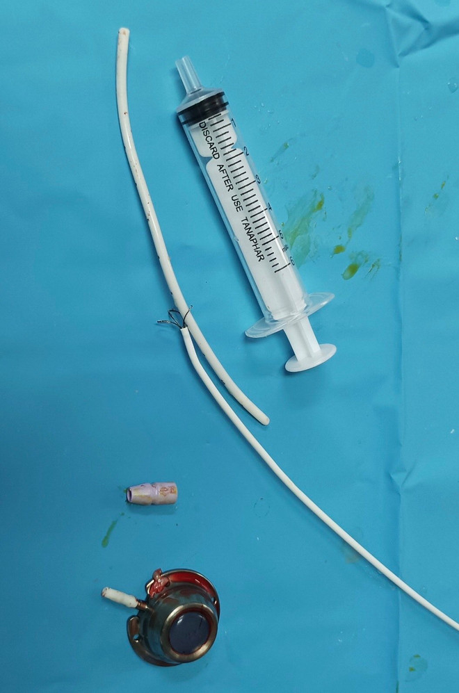 Can thiệp mạch lấy dị vật mắc kẹt ở tim người bệnh mắc ung thư ảnh 2