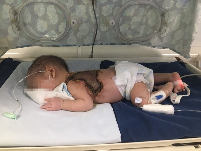 Người nhà tự ý lấy kim chích mụn, 1 trẻ sơ sinh nhiễm trùng huyết nặng ảnh 1