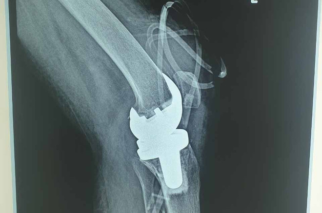 Lần đầu tiên bác sỹ Việt Nam thay khớp gối nhân tạo cho người mắc lao ảnh 1