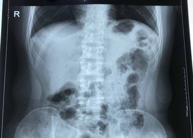 Hà Nội: Nam thanh niên viêm ruột thừa cấp có trái tim bên phải ảnh 1