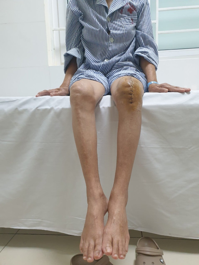 Lần đầu tiên bác sỹ Việt Nam thay khớp gối nhân tạo cho người mắc lao ảnh 2