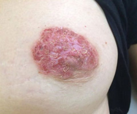 Phát hiện và điều trị thành công thể ung thư vú hiếm gặp ảnh 2