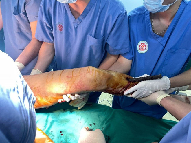 Cấp cứu thành công thanh niên bị tai nạn 3 cọc sắt đâm xuyên người ảnh 1