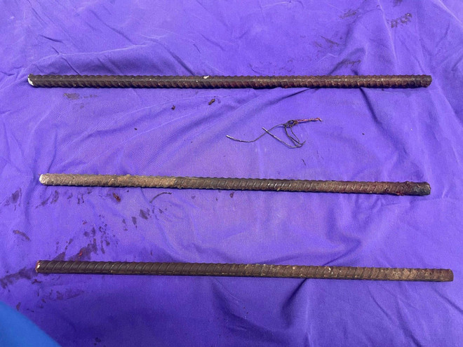 Cấp cứu thành công thanh niên bị tai nạn 3 cọc sắt đâm xuyên người ảnh 2