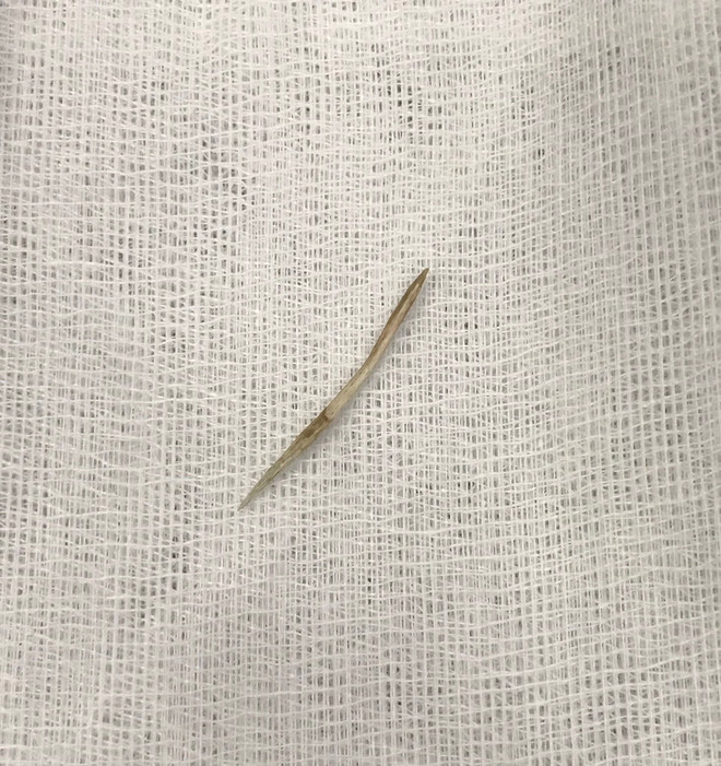 Cô gái 17 tuổi bị thủng ruột, nhiễm trùng ổ bụng vì nuốt tăm ảnh 2