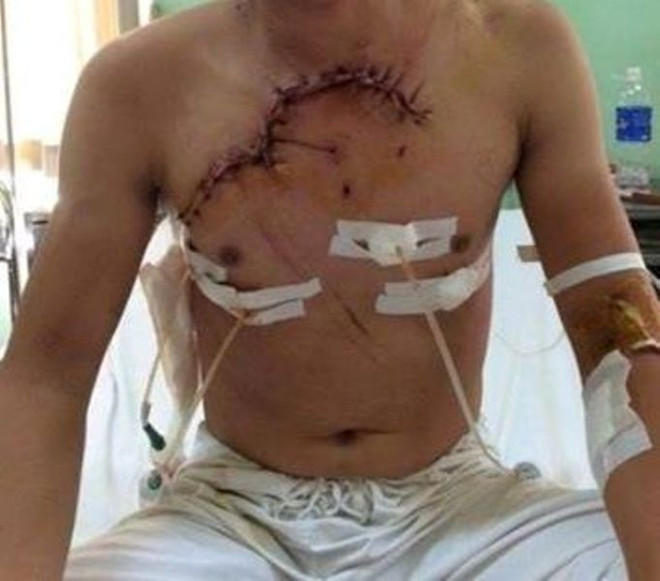 Cứu sống một bệnh nhân có tim và phổi lộ ra ngoài vì tai nạn ảnh 1