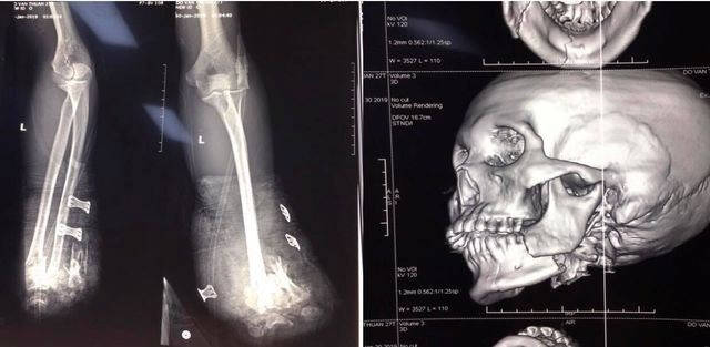 Gần 300 trường hợp nhập viện cấp cứu do tai nạn pháo nổ ảnh 1