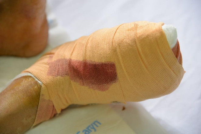 Biến chứng đái tháo đường: Cắt cụt chân vì tự ý điều trị kháng sinh ảnh 1