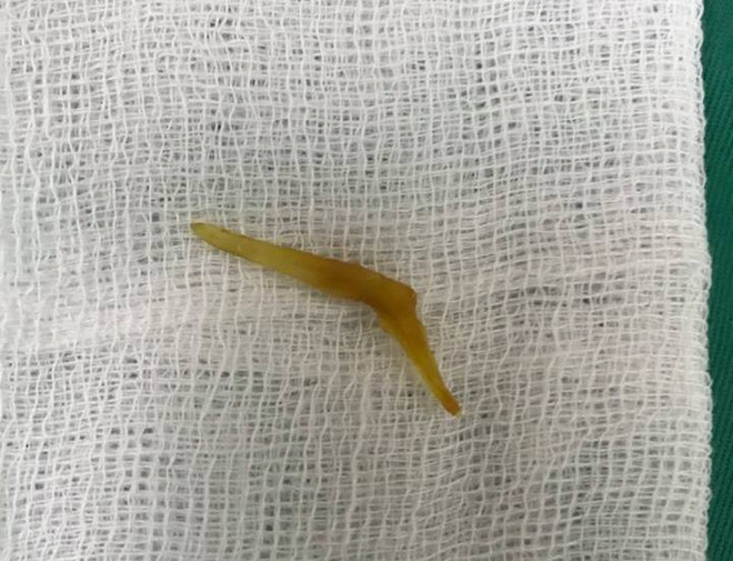 Nam thanh niên thủng ruột vì nuốt chiếc xương cá dài 4 cm ảnh 2