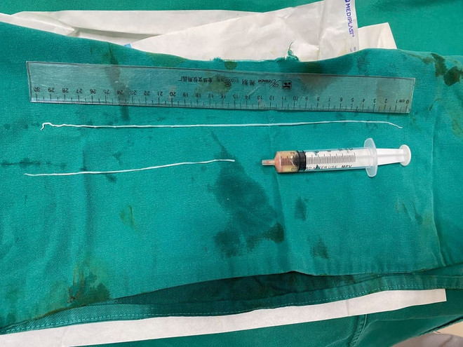 Gắp những con giun dài tới 60cm ở bắp tay 1 thanh niên ở Yên Bái ảnh 1