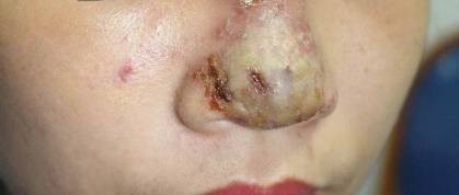 Liên tiếp các ca tai biến thẩm mỹ do tiêm chất làm đầy môi, mắt ảnh 3