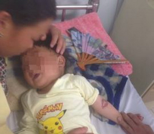 Ăn nhầm hóa chất, bé trai bị bỏng miệng và thực quản dạ dày ảnh 1