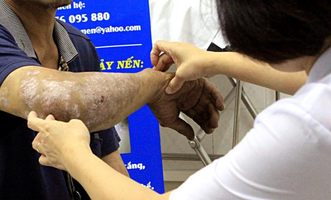 Thực hư thuốc điều trị Lupus ban đỏ không được bảo hiểm thanh toán ảnh 1