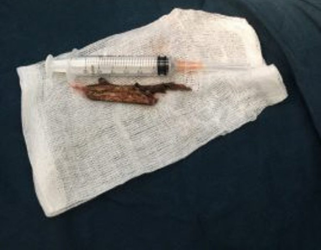 Cứu sống bé trai bị cành cây dài 8cm đâm xuyên vùng cổ ảnh 1