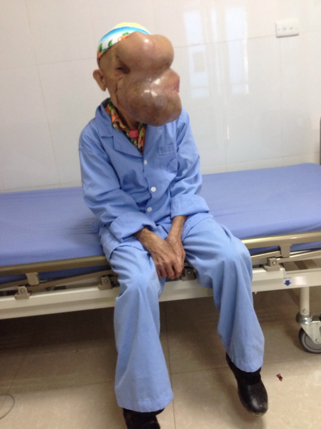 Cụ bà bị khối u khổng lồ chèn gần hết trên khuôn mặt ảnh 2