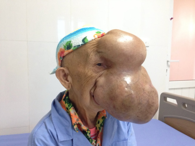 Cụ bà bị khối u khổng lồ chèn gần hết trên khuôn mặt ảnh 1