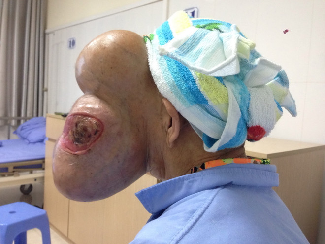 Cụ bà bị khối u khổng lồ chèn gần hết trên khuôn mặt ảnh 3