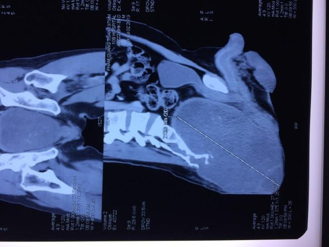 Cắt khối u khổng lồ vùng xương cùng cụt cho một bệnh nhân ảnh 1