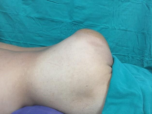 Cắt khối u khổng lồ vùng xương cùng cụt cho một bệnh nhân ảnh 2