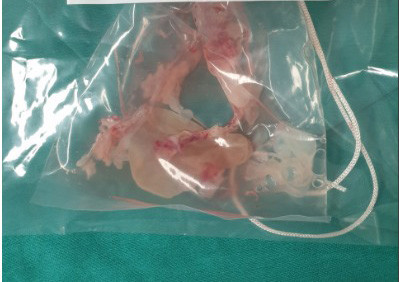 Phẫu thuật cứu bệnh nhân có ổ sán khổng lồ trong não ảnh 1