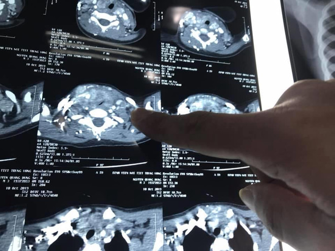 Bé trai 3 tuổi mắc ung thư tuyến giáp, di căn nhiều hạch ảnh 2