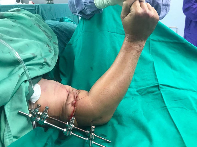 'Hồi sinh' kỳ diệu cho một bệnh nhân có cánh tay bị đứt rời hoàn toàn ảnh 2