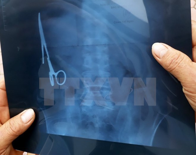 Hình ảnh chụp X-quang chiếc kéo trong ổ bụng của ông Nhật. (Ảnh: Bùi Đức Hiếu/TTXVN) Xác minh sự việc bỏ quên kéo 18 năm trong bụng bệnh nhân ảnh 1