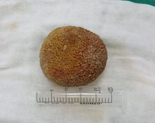 Cắt bỏ viên sỏi thận nặng 0,5kg trong bụng một bệnh nhân ảnh 1