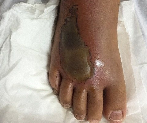 Mùa rắn sinh sôi: Nhiều trẻ bị rắn cắn phải nhập viện vì hoại tử chân ảnh 1