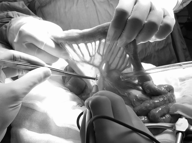 Ghép nối ruột tái tạo đường ăn cho người bệnh ung thư thanh quản ảnh 2