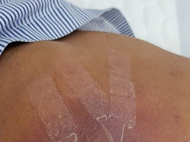 Hà Nội: Trẻ 5 tuổi bị hoại tử da vùng bụng do dán cao trị mụn ảnh 1