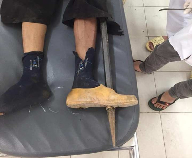 Một nam thanh niên bị xà beng đâm thủng bàn chân trái ảnh 1