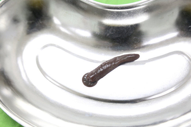 Người đàn ông "nuôi" một con đỉa dài 10cm trong... cổ họng ảnh 1