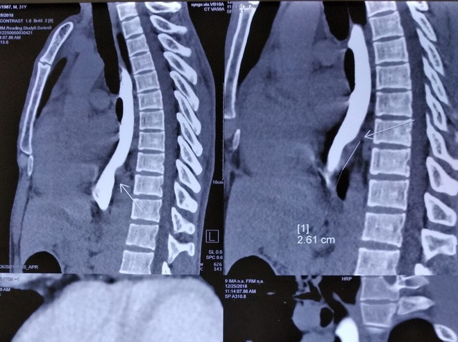 Bệnh viện K: Nội soi 3D lồng ngực mở u xơ lấy dị vật xương cá ảnh 1