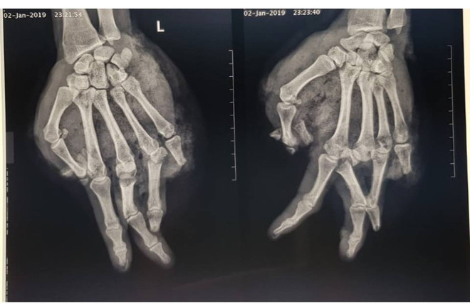 Bị bầm dập, lóc da bàn tay vì thay bình gas mini khi ăn lẩu ảnh 1