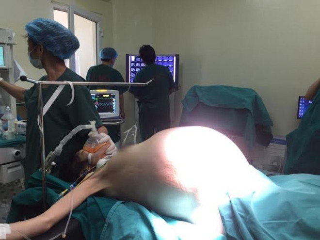 Cắt bỏ khối u buồng trứng nặng 16 kg trong bụng một cô gái ảnh 1