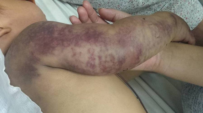 Cứu sống em bé 2 tuổi người H’Mông bị rắn độc cắn rất nặng ảnh 3