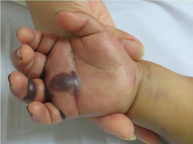 Cứu sống em bé 2 tuổi người H’Mông bị rắn độc cắn rất nặng ảnh 2